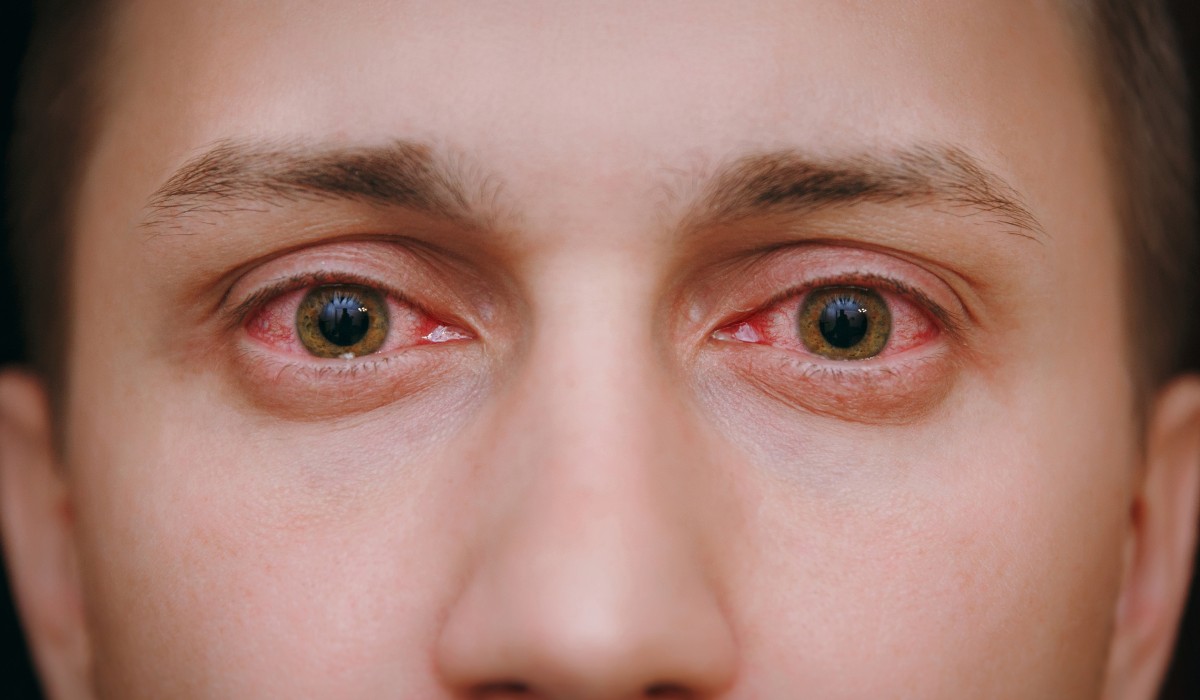 Göz İçi İltihapları