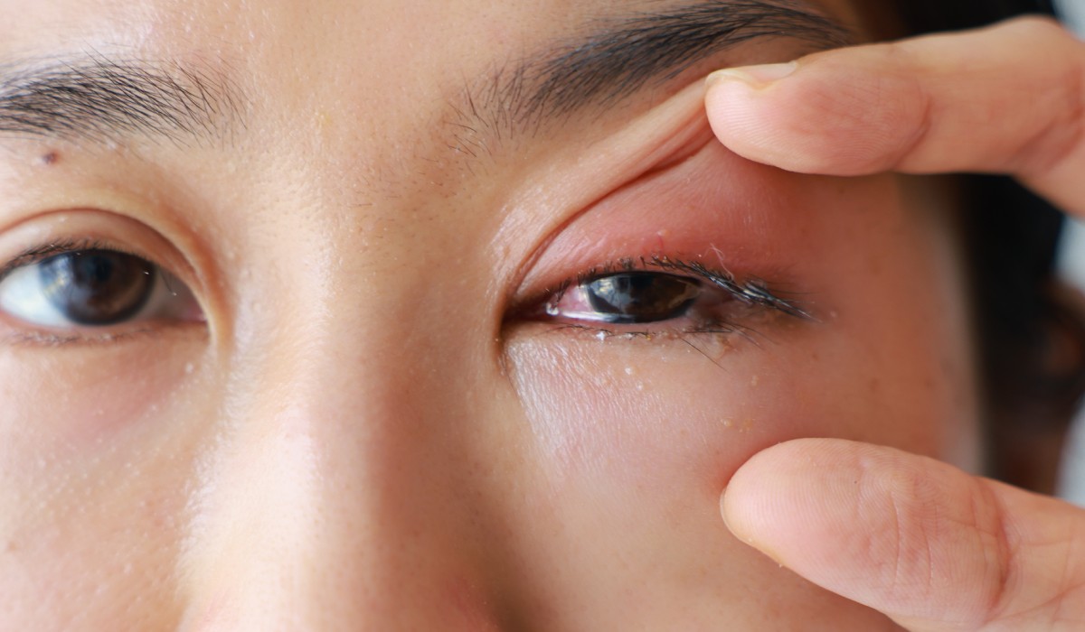 Göz İçi Tümörler